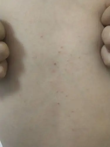 女儿几年前前胸突然长的小疙瘩