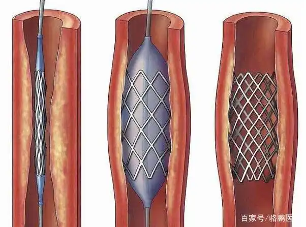 心脏支架手术属于"缺德害人"吗?装上人就完了?看完或许明白了