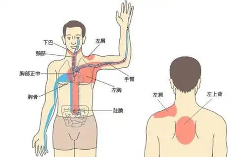 判断心绞痛最典型的表现为阵发性,也就是突然发生的胸闷,气短,胸痛
