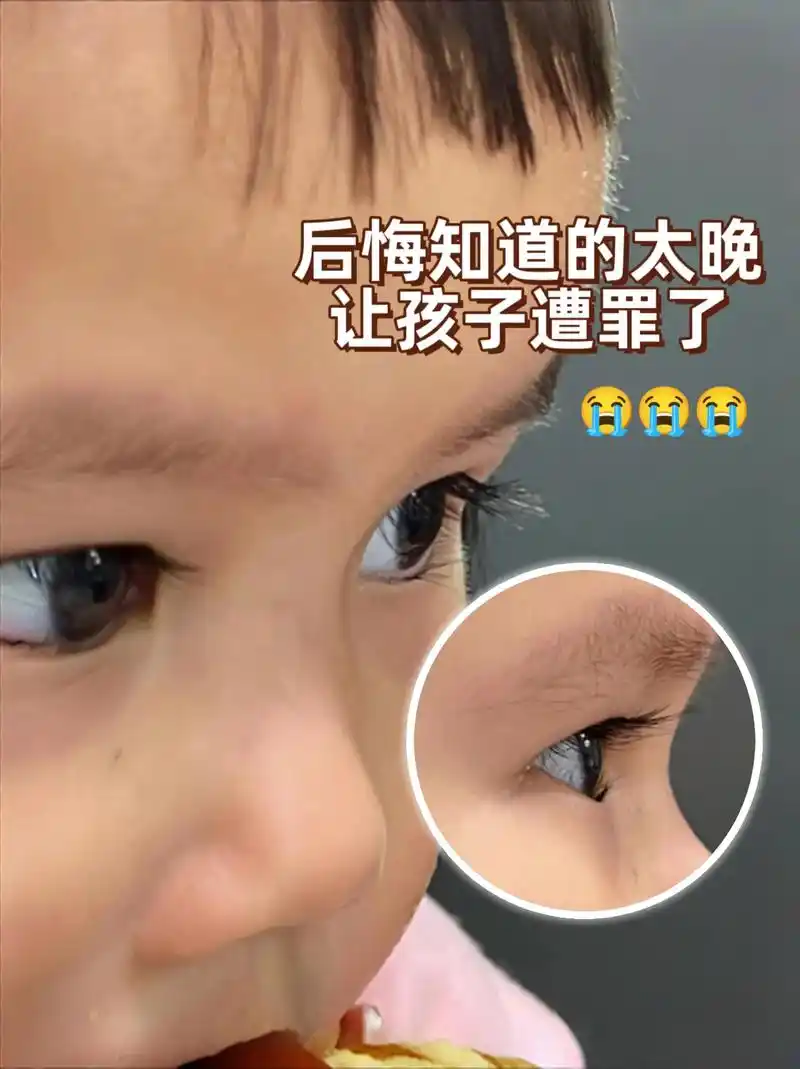 孩子健康无小事,倒睫毛不容忽视