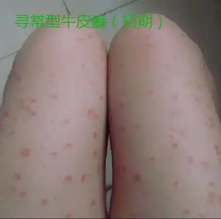 牛皮癣(银屑病)图片 - 抖音