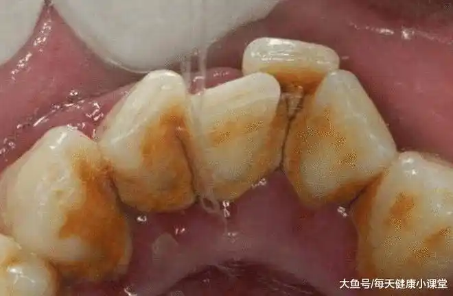偶尔发现自己的牙齿内侧有黄色的污垢看老中医如何一招去除