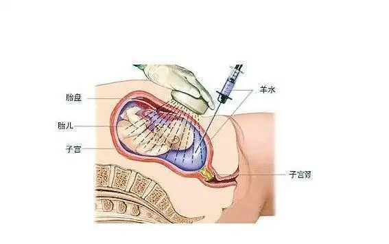 诊断胎儿是否有染色体方面或神经管的缺陷,通常在怀孕16～20周实施