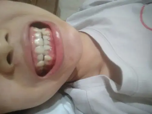 请问我这牙龈萎缩得很严重了么?