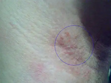 胳肢窝 起了一小片红疙瘩 皮肤专家请进!