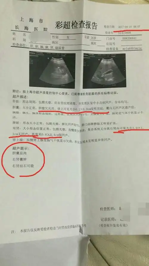 李氏砭法治疗胆囊息肉及肾囊肿