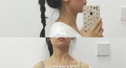 这斜方肌这富贵包怎么办 还有救嘛 已经练欧阳春晓一周了 求救98