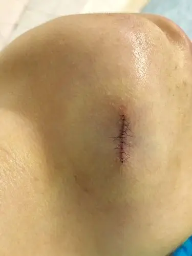 黑毛痣切除术术式选择 - 好大夫在线