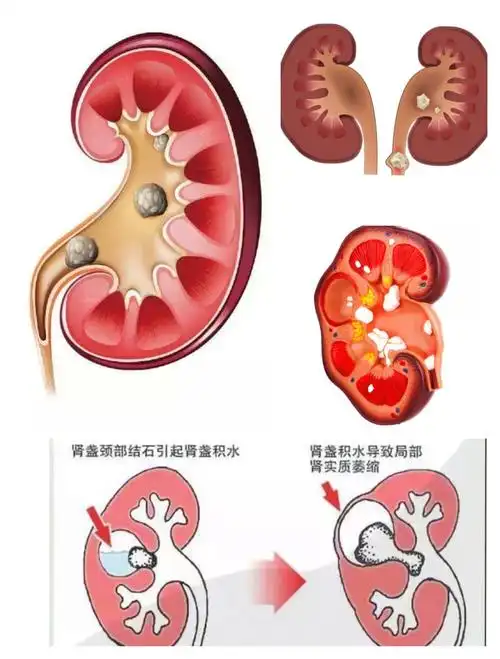 【秀医超声小课堂】——肾脏内的强回声不一定是结石