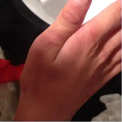 孩子7周岁没到,这半年手背这手指长了硬茧,开始一块,现在每个手指都有