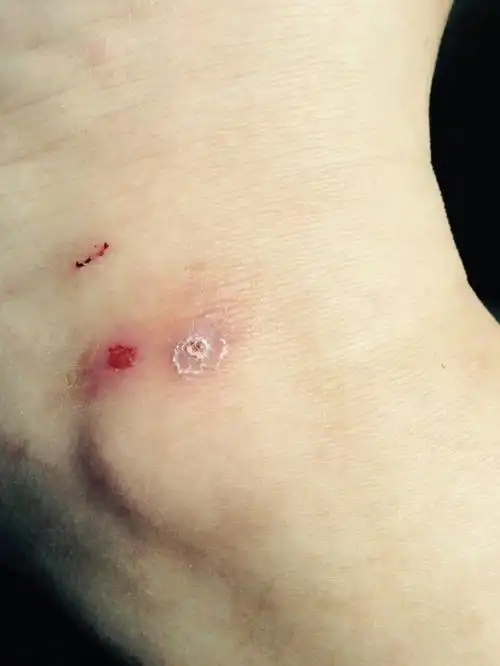 我的皮肤比较毒,被虫子咬后很难愈合?