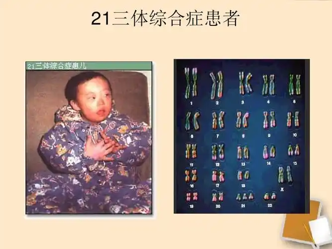 21三体综合症患者