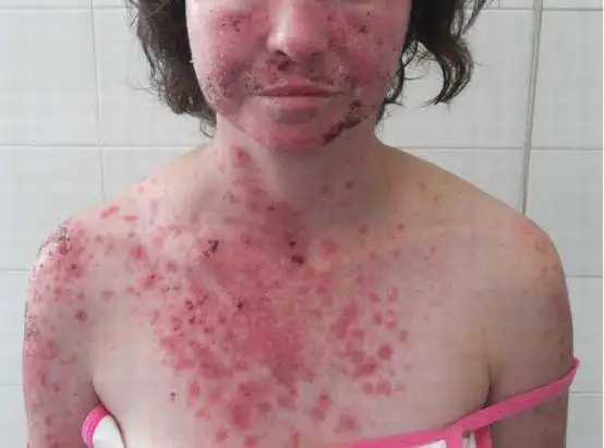 红斑狼疮的"光敏感",究竟是什么?