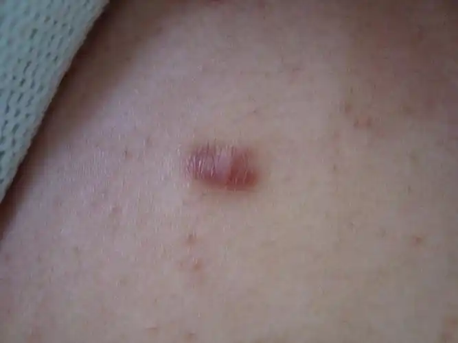 楼主zyyu20082009-05-21 17:26:06患女,24岁,双侧臀部出现疤痕疙瘩样