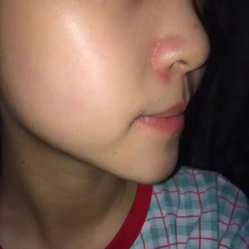 鼻翼痘为鼻子两侧长的<a target="