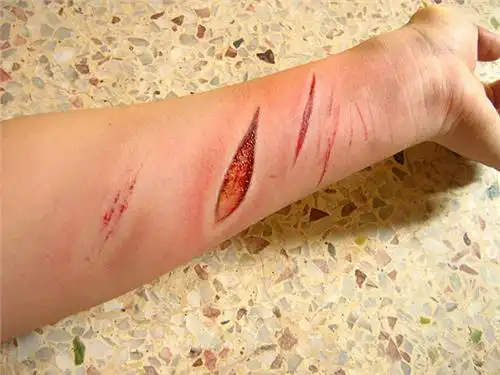 缝针的伤口多久才能完全恢复