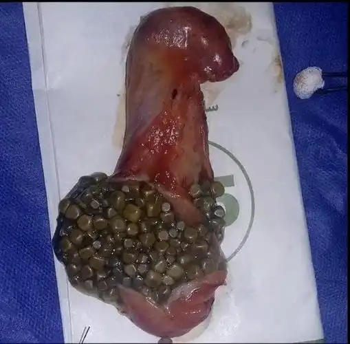 突然想到一个问题:胆结石和珍珠的区别