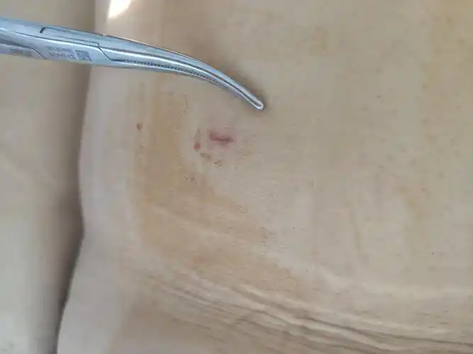 "单侧入路,双侧弥散"微创骨水泥快速解决老年腰椎压缩骨折