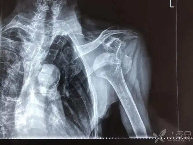一个危险的肩关节脱位