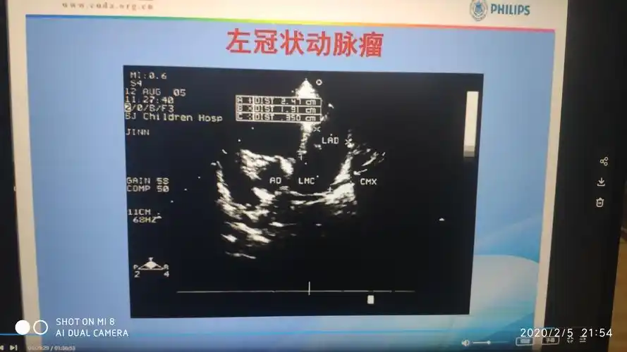 冠状动脉超声扫查,川崎病