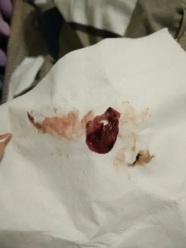 女人问题,月经非常暗红!还流出这个,怎么回事?看图前请做好心里准备!