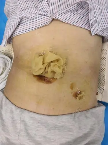 再生医学技术系列报道之六十一一1例腹部切口不愈合伤