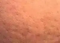 6,乳房橘皮乳头周围的皮肤,发红瘙痒,一定不能忽视,不要以为这是过敏