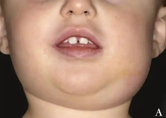 流行性腮腺炎冬春季高发家长需警惕严重可致耳聋不育