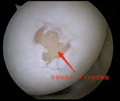 关节软骨损伤怎么办膝关节软骨磨损如何治疗