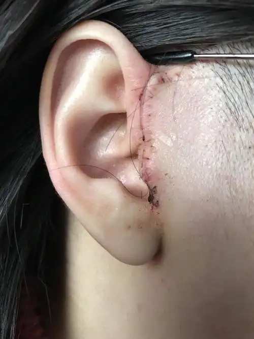 颞颌关节手术 写在最前面,我不是医生,具体的我也不懂,只能告诉大家我