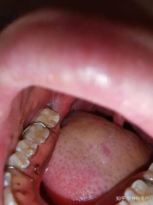 拔了智齿留的洞会长好吗? - 知乎
