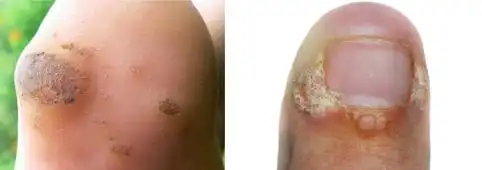 一院技术皮肤疣不可怕济宁市第一人民医院治疣有了新