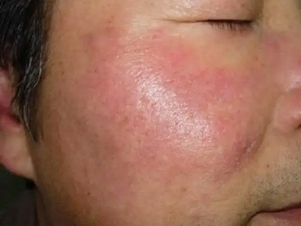 偏方治疗日光性皮炎