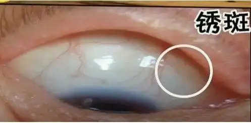 可以让小伙伴视察下自己的眼白哦,记得转动眼珠,眼球上方,下方多看看