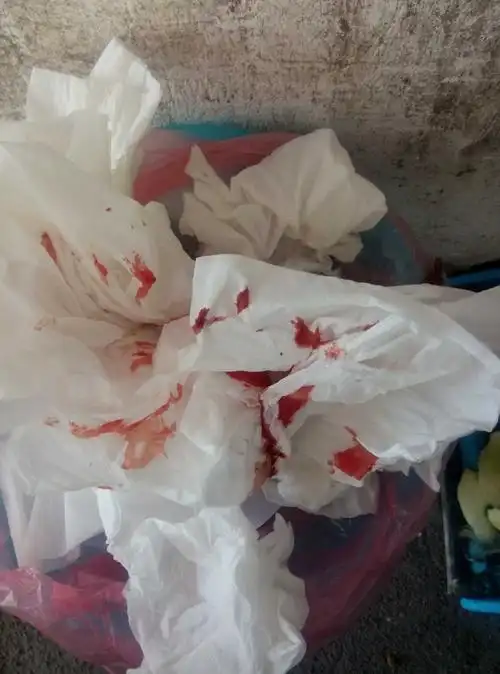 怀孕50天早上吐血了,吐了好多,而且还是血块