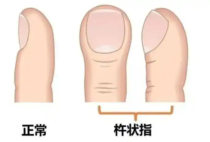 1,杵状指一些病人的指尖或足尖肿胀,使得手指和脚趾看上去就像一个"