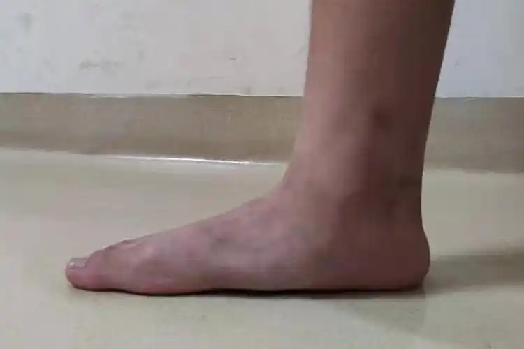 扁平足不同年龄段应该怎么治疗