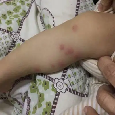 宝宝这两天腿上长了红色的疙瘩,是怎麼回事?