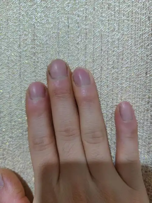 旅人丶 的想法: 能帮我看看是杵状指吗,突起那里每天都是… - 知乎