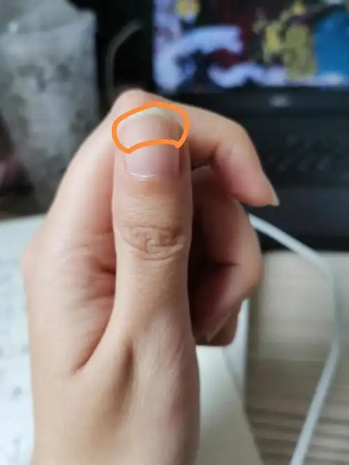 指甲上长了白色弧线好像已解决