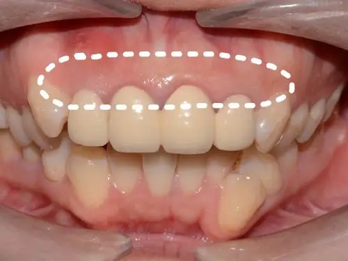 【二氧化锆全瓷牙】爱尔创二氧化锆全瓷牙修复牙齿缺失缺损变色牙修复