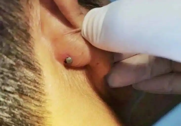 进入高发季,已有人中招!处理不当很危险_皮肤_虫子_奶奶