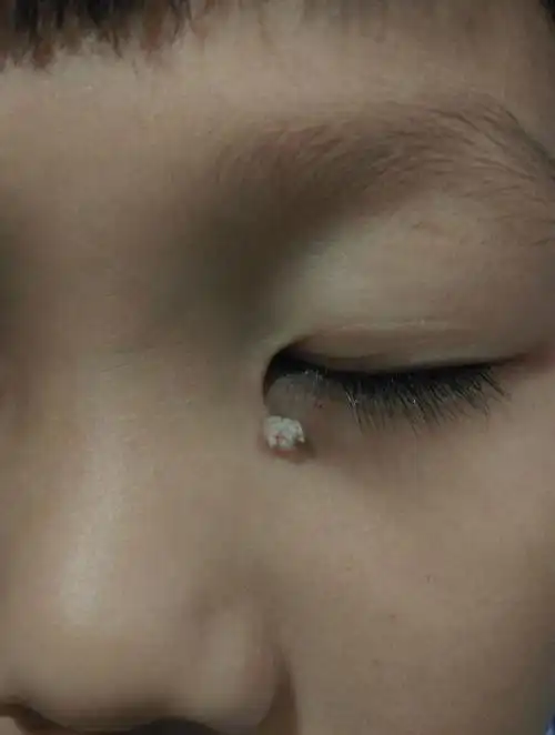 儿子眼角下长了个东西,问下是什么瘊子