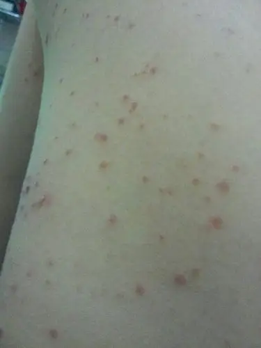 全身起满了这样的红疹,痒得不是很厉害,但