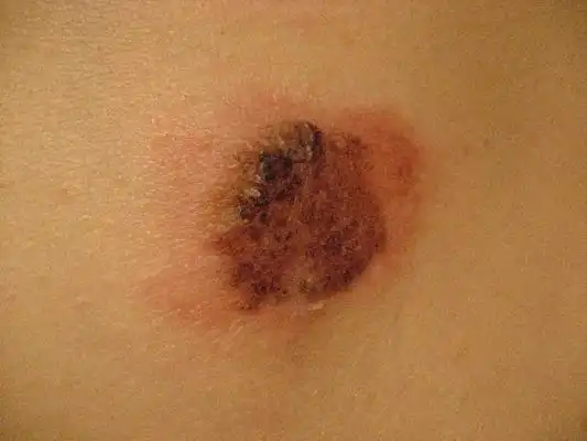 容易癌变的黑痣图片6