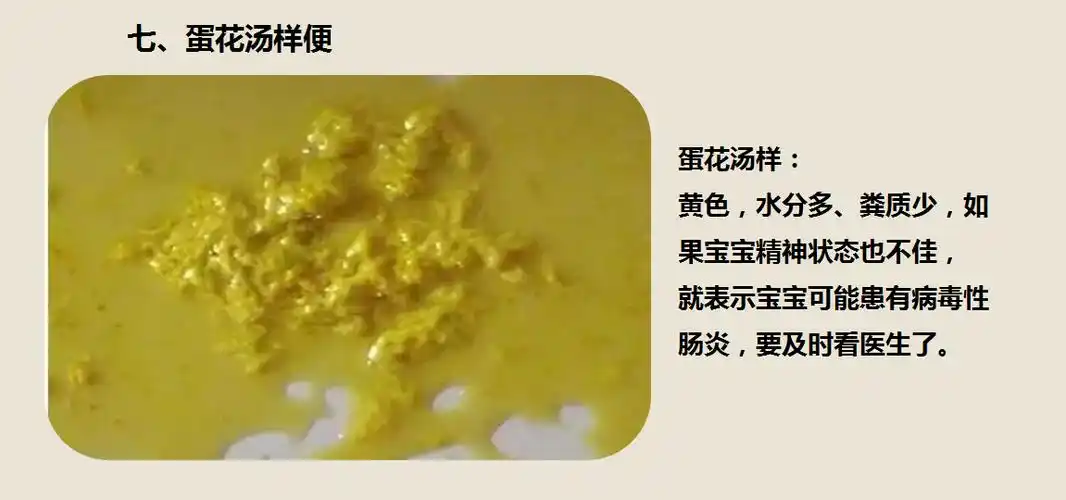 七,蛋花样便六,油状便图示五,奶瓣便图示四,泡沫便图示三,绿便图示二