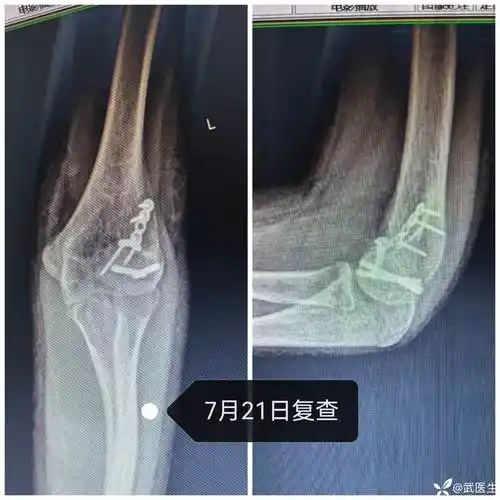 一例儿童肘关节骨折,如果第一次自己接诊,会漏诊么?