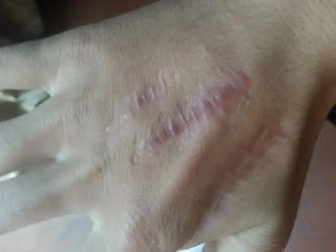 伤口深手术后增生性疤痕图片