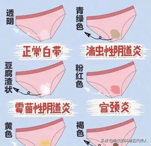 白带异常的表现有哪些(白带异常有哪几种症状)