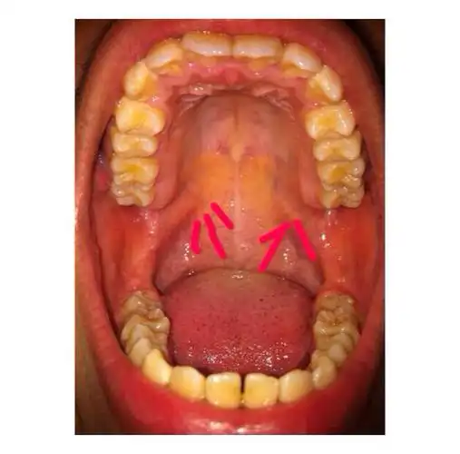 我的口腔正常么?还有突出的是什么,感觉是
